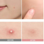 Точечные патчи от прыщей - Skin 1004 Spot Cover Patch - Фото 4
